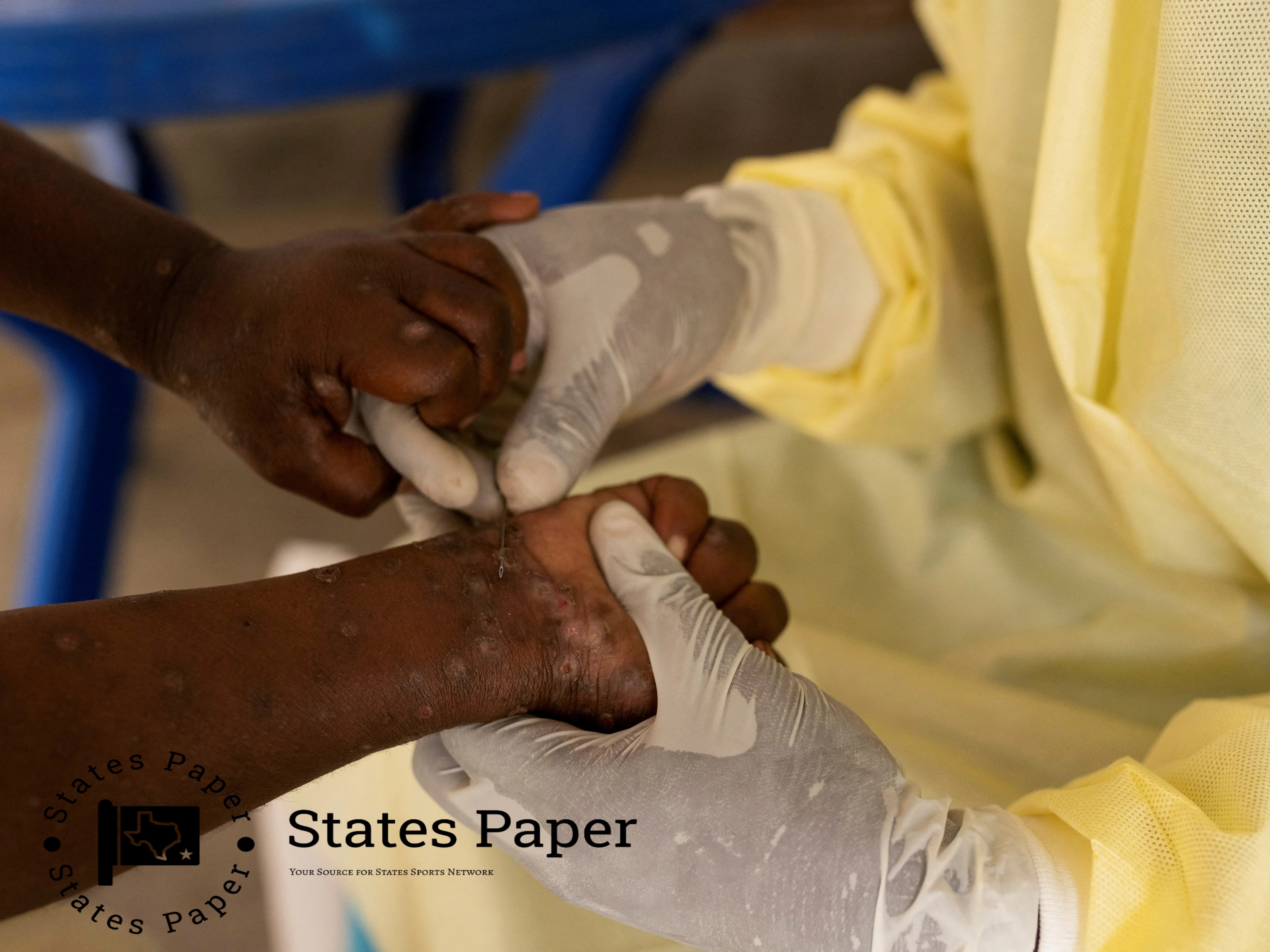 As mpox continues to cross borders, is the US prepared for an outbreak?